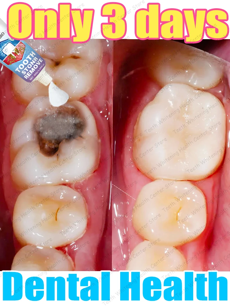 Contains Probiotics to Repair Tooth Decay and Clean Teeth 1005008912750225
